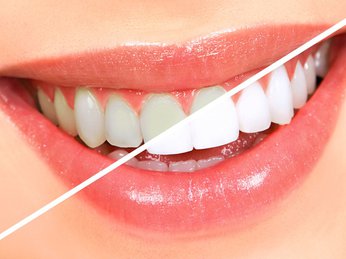 Cách tẩy trắng răng tại nhà với việc sử dụng các nguyên liệu có sẵn trong nhà